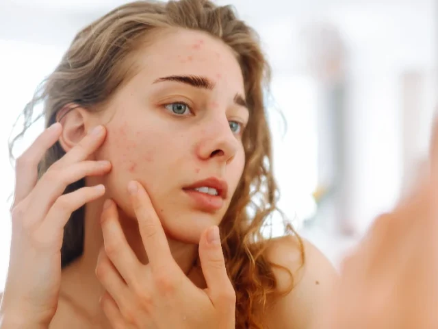 Motivos del acné hormonal